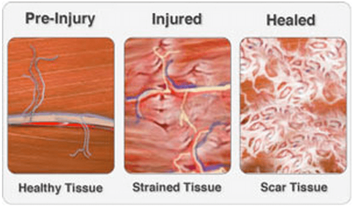 Formation of scar tissue following muscle strain